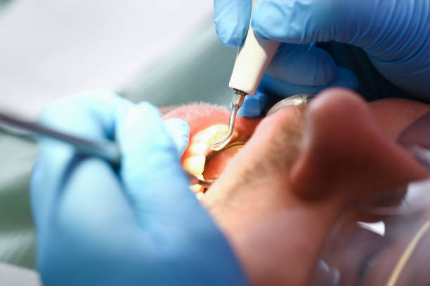 Best Chipped Tooth Repair Near Me  in Kilauea, HI